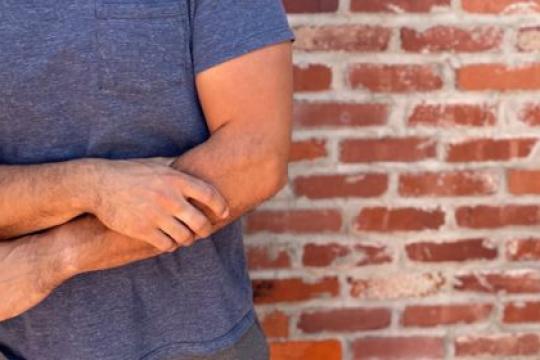 我如何治疗网球肘的经历分享