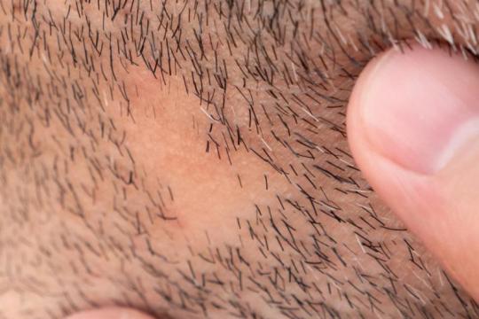 对稀疏的面部毛发不满意？这篇文章或许能帮到你