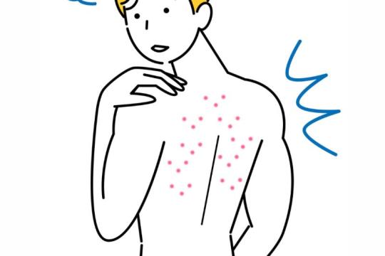 皮肤科医生推荐的10个祛除背部痤疮的有效方法