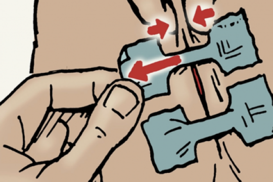 简易止血闭合伤口的应急方法