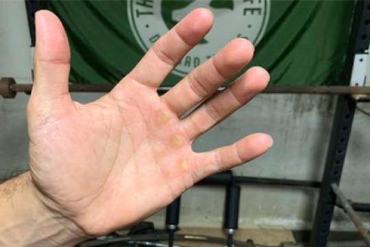 如何护理你的老茧