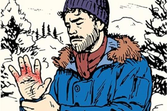 本周技能：如何处理冻伤