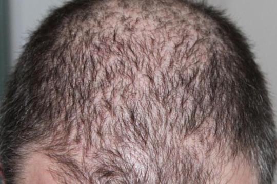 这种头皮“面部护理”能有效治疗脱发和头发稀疏