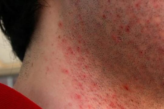 如何有效预防剃须刀烧伤