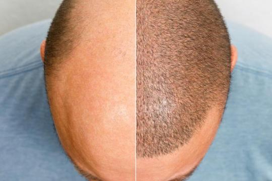 揭秘“土耳其发际线”治疗脱发的真相（附前后对比图）