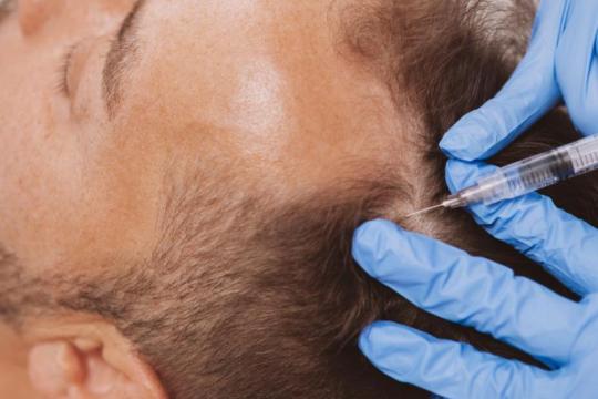 虽然还没有脱发的“根治”方法，但确实有有效的治疗手段