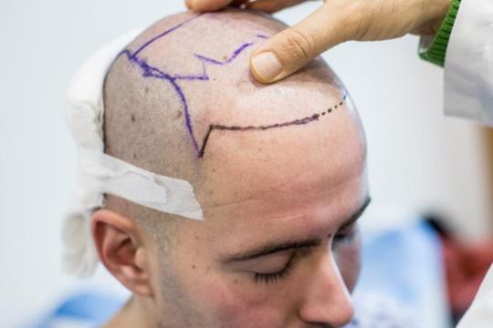 知名植发专家分享关于植发的见解