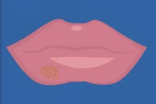 担心脸部性传播感染引起过多关注？这样做最有效